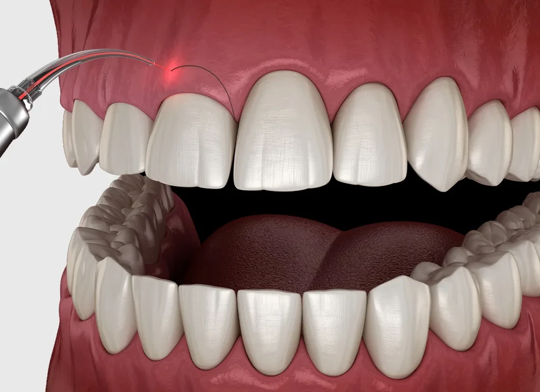Gum Contouring in Redlands, CA