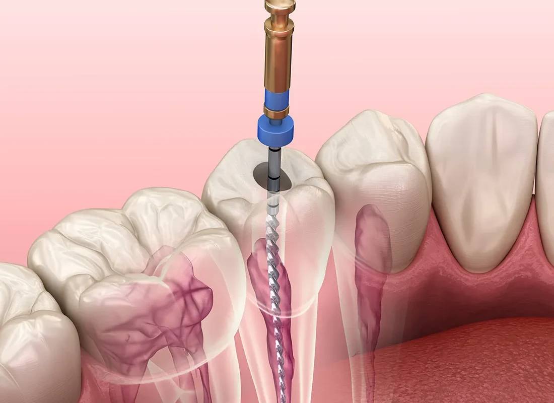 Root Canal Treatment at Dentist of Redlands