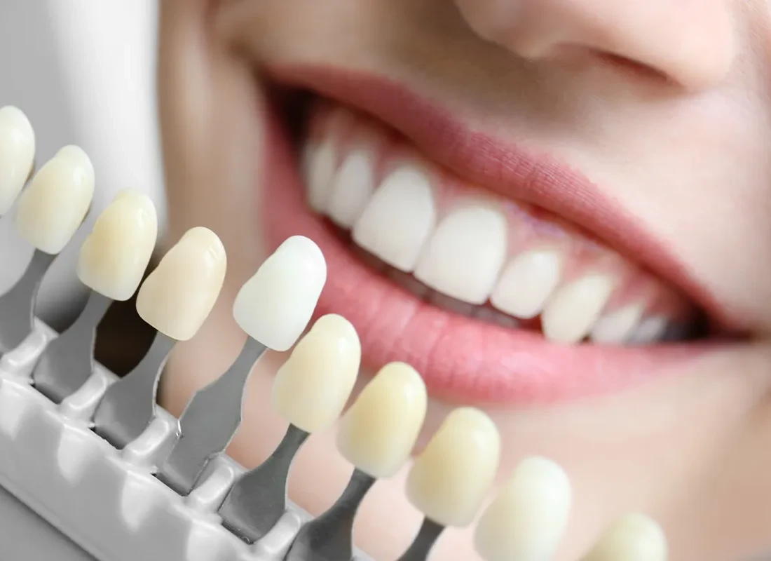 Professional Teeth Whitening at Dentist of Redlands