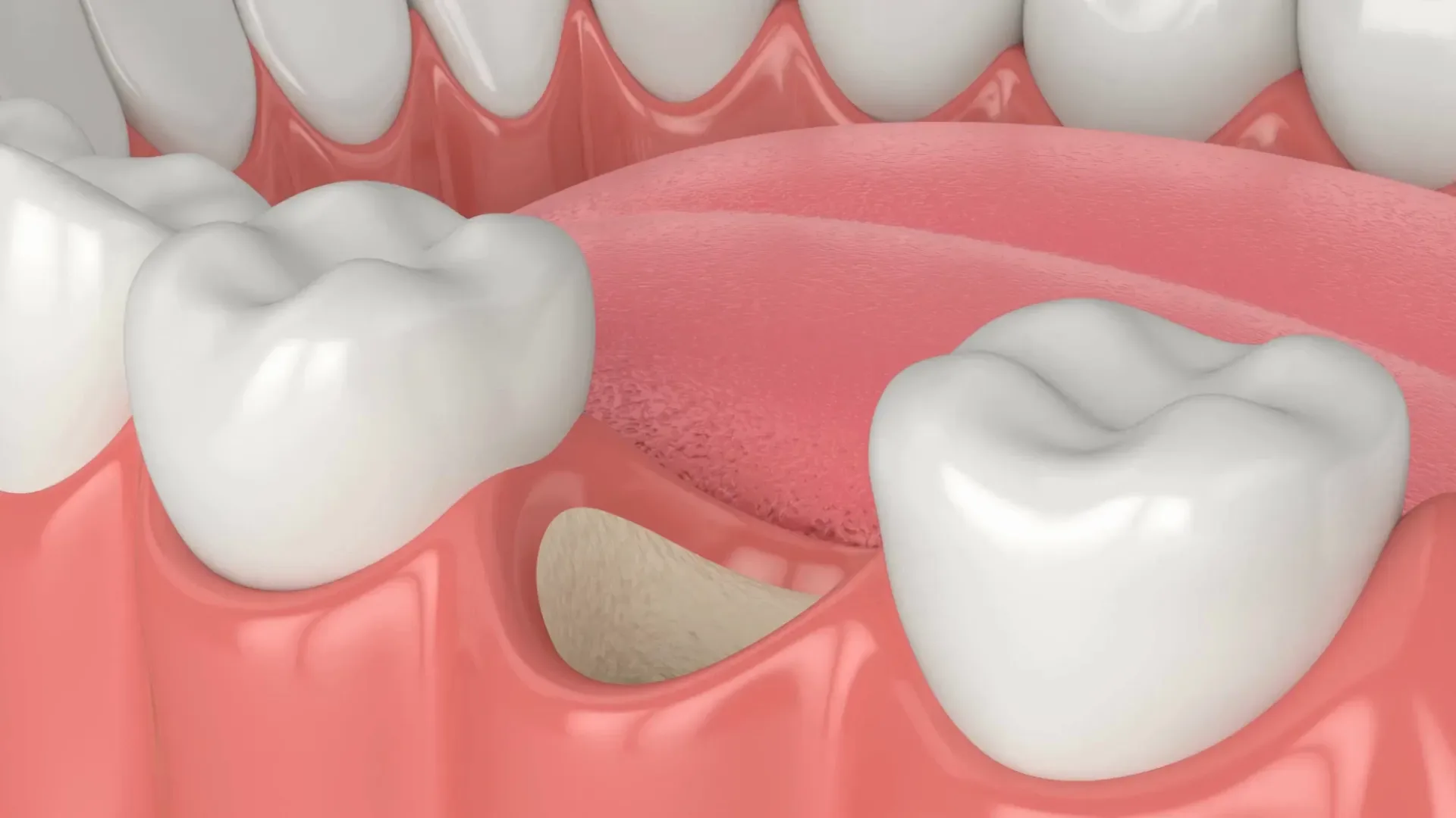 Dental Bone Grafting in Redlands, CA