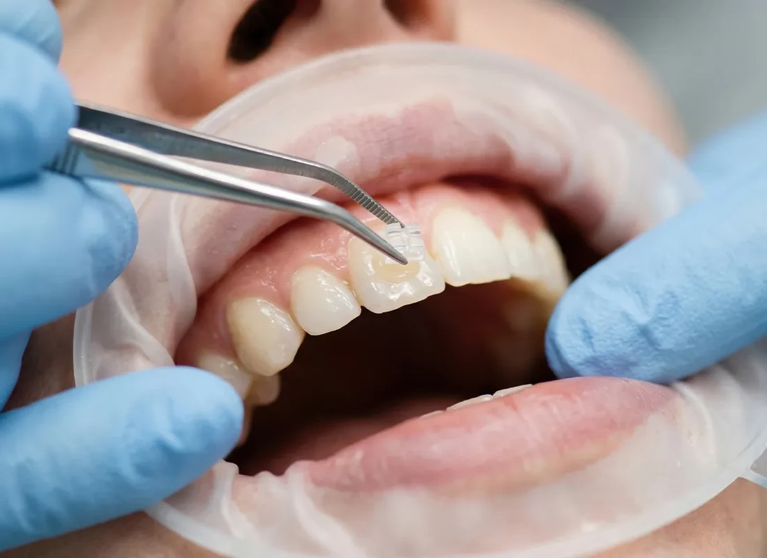 Dental Bonding in Redlands, CA