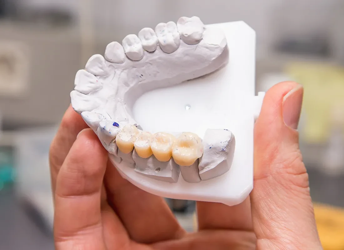 Dental Bridges at Dentist of Redlands