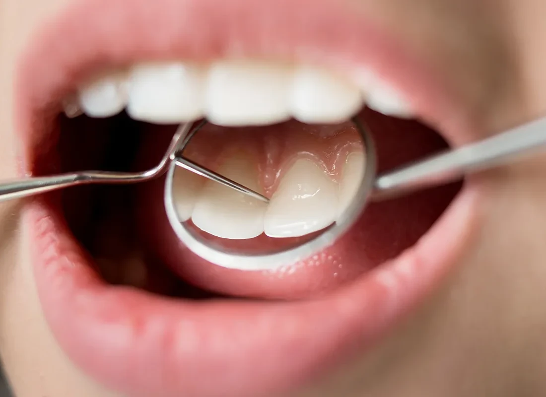 Dental Cleaning in Redlands, CA
