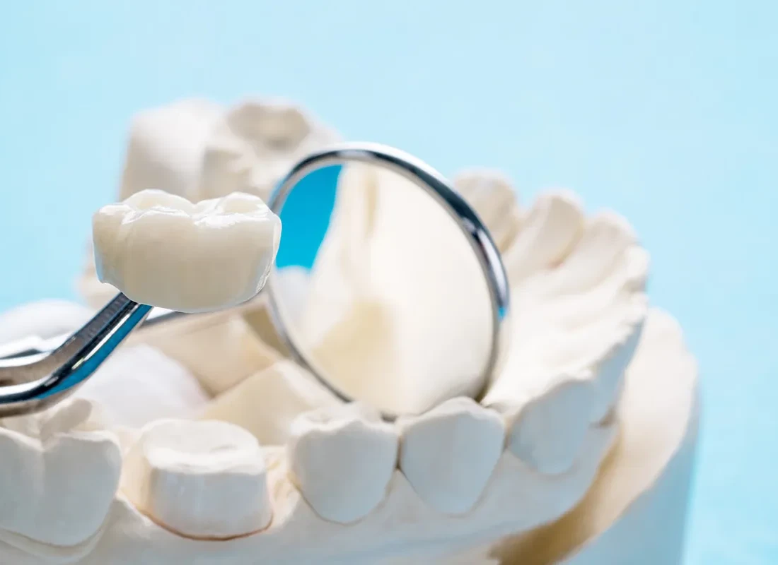Dental Crowns at Dentist of Redlands