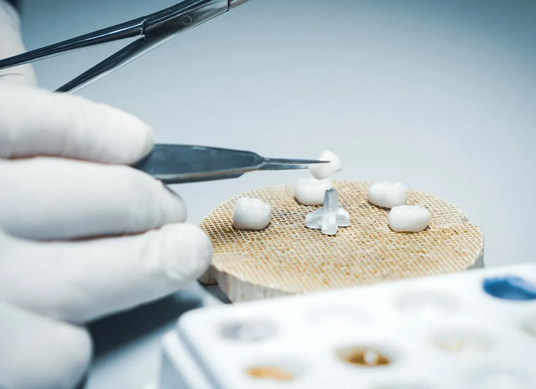 Signs you may need dental crowns — Dentist of Redlands