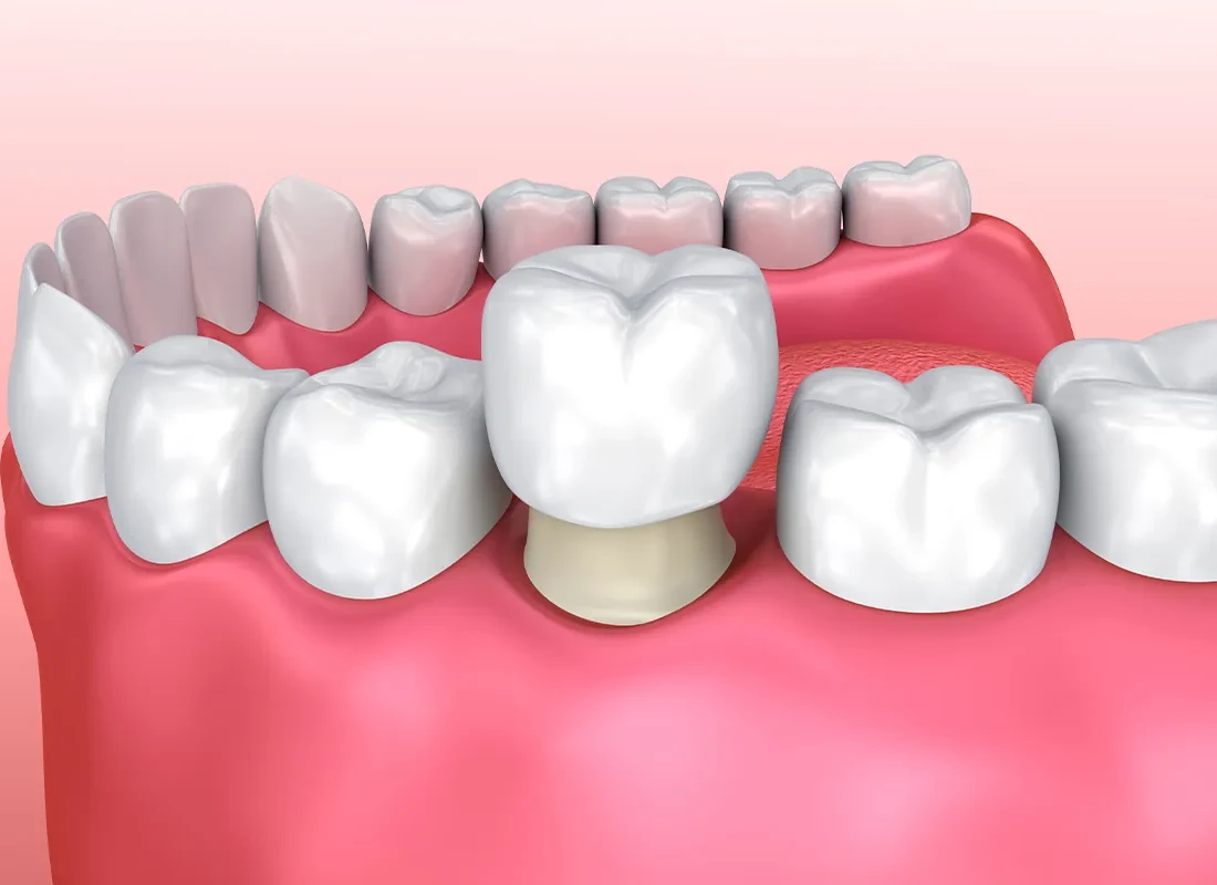 Restorative Dentistry at Dentist of Redlands