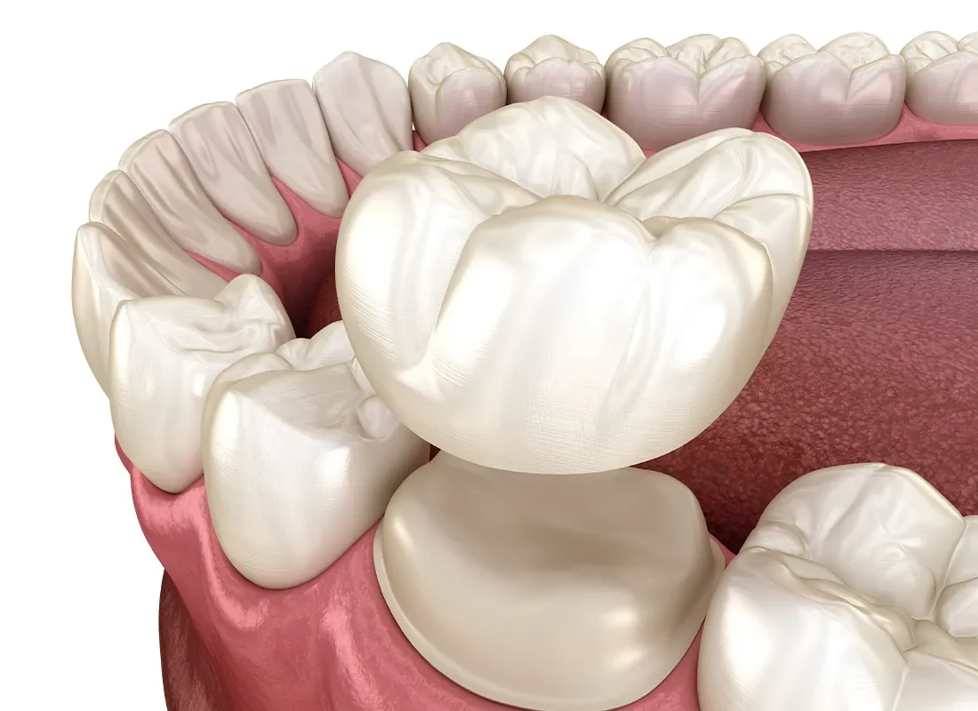 Dental Crowns in Redlands, CA