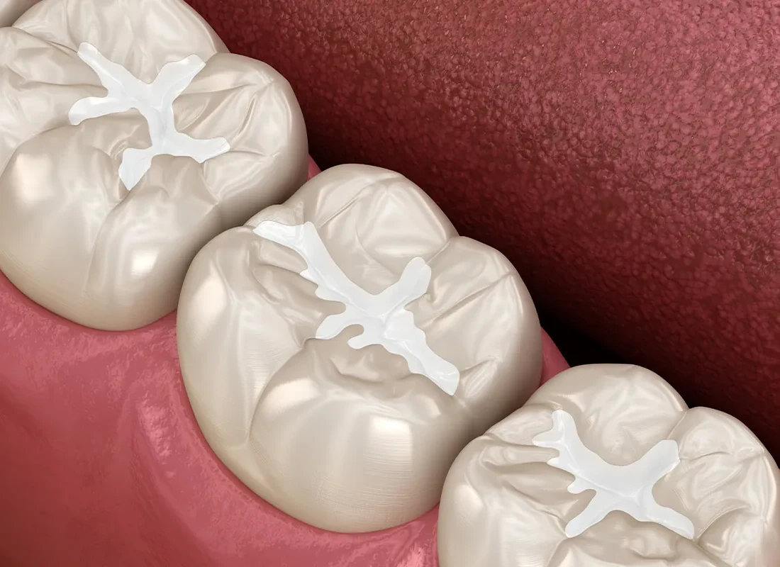 Dental Fillings at Dentist of Redlands