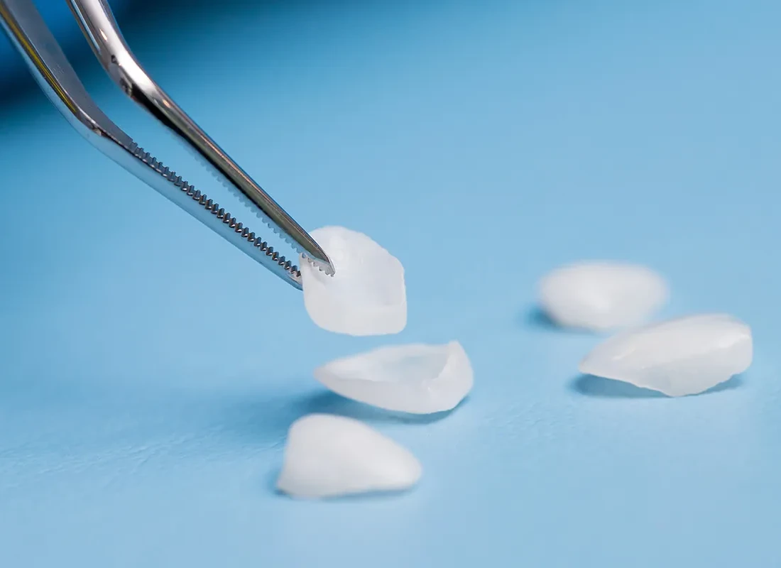 Dental Veneers at Dentist of Redlands