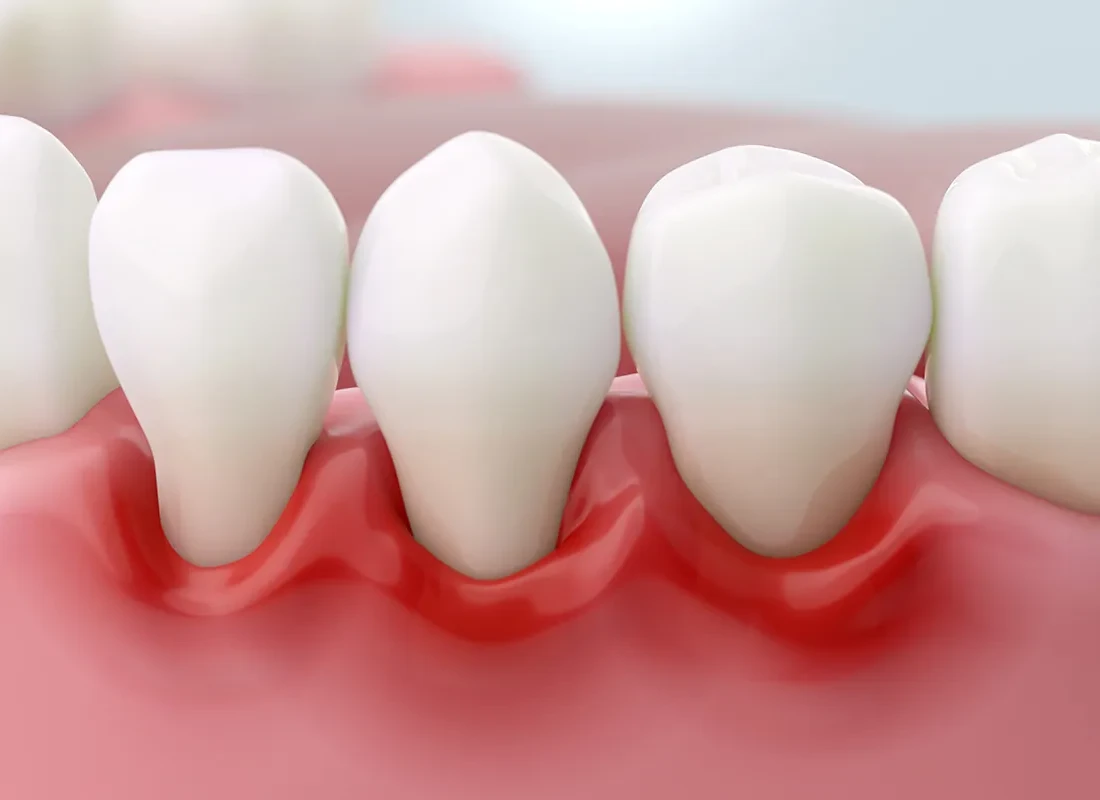 Gum Grafting in Redlands, CA
