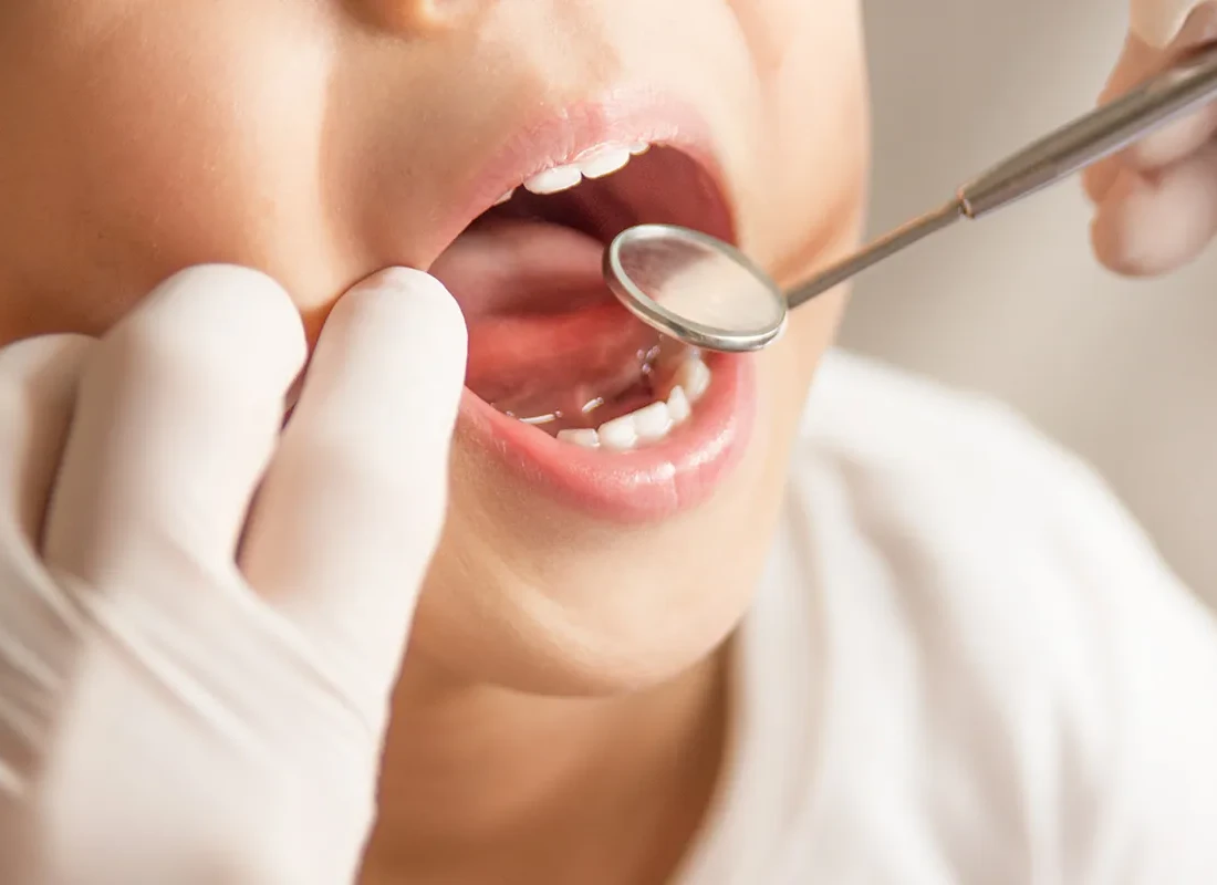 Fluoride Treatments at Dentist of Redlands