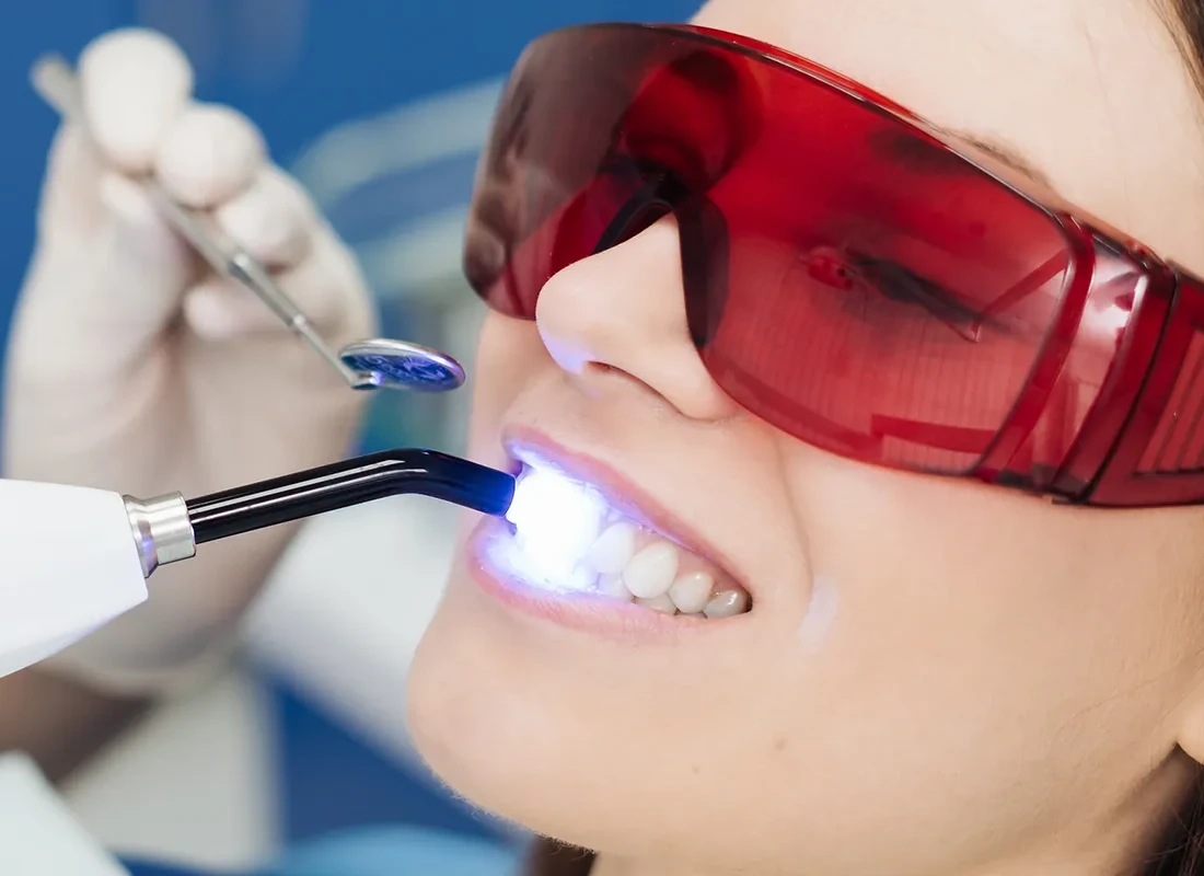 Gum Contouring at Dentist of Redlands