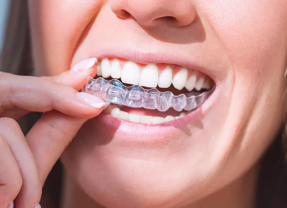 Mouth Guards in Redlands, CA