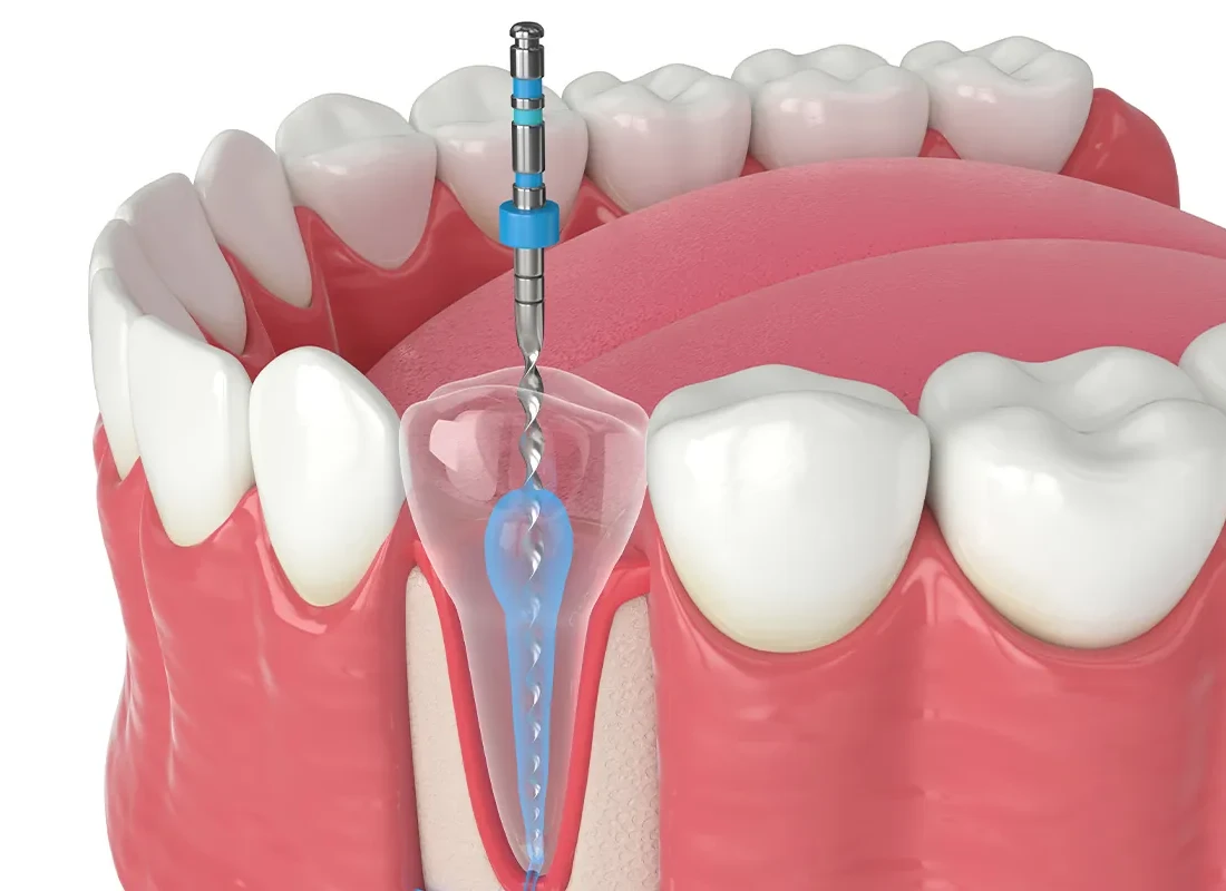 What Is a Root Canal and Does It Hurt?