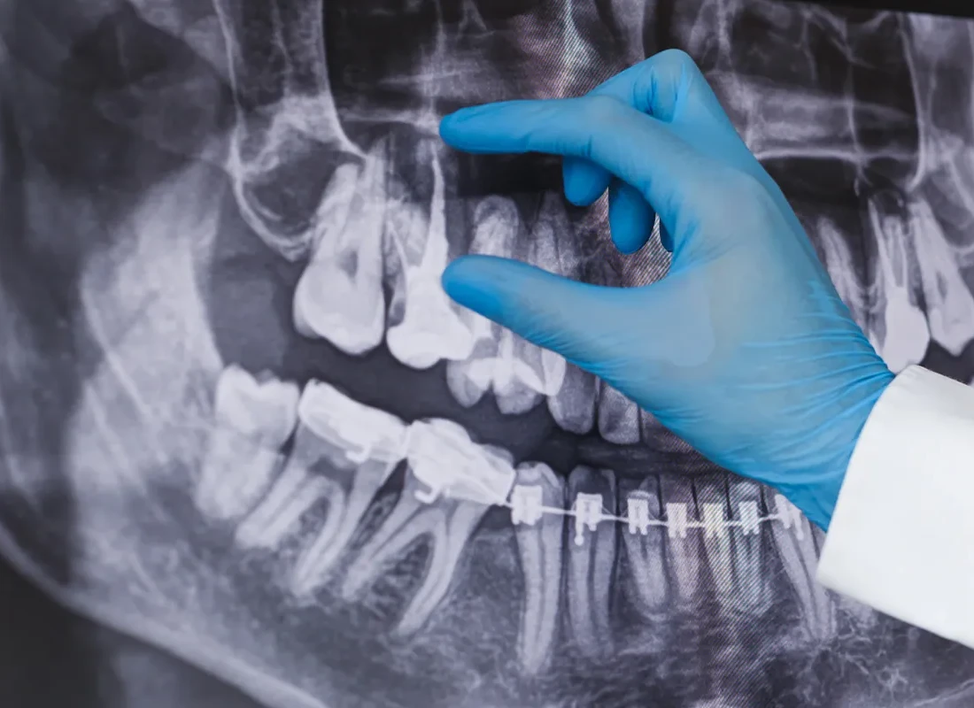 Signs you may need root canal treatment — Dentist of Redlands