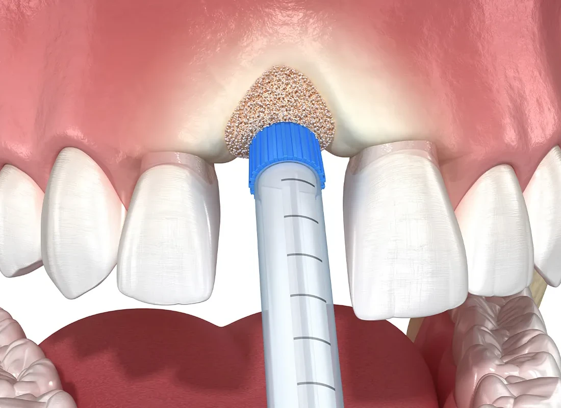 Dental Bone Grafting at Dentist of Redlands