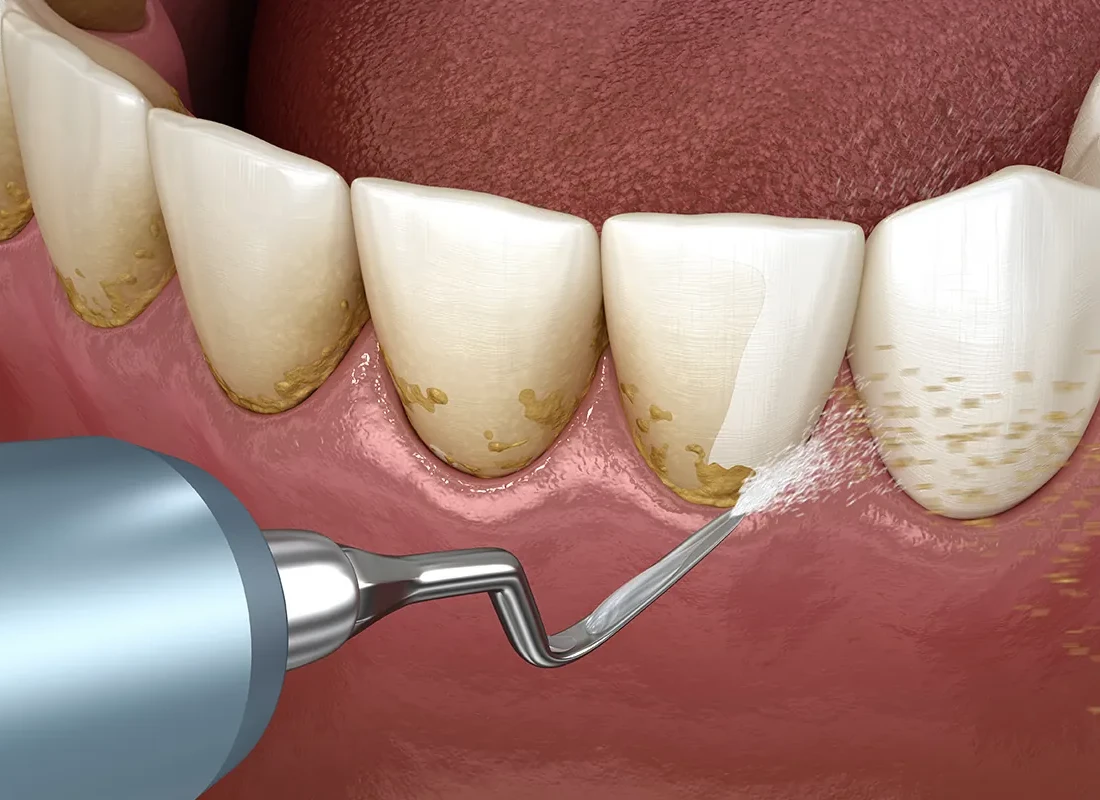 Dental Cleaning at Dentist of Redlands