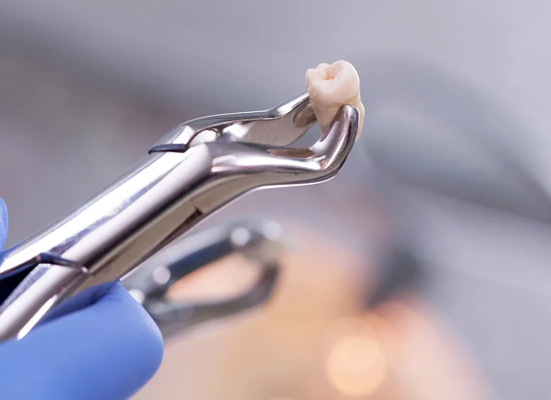 Tooth Extraction at Dentist of Redlands
