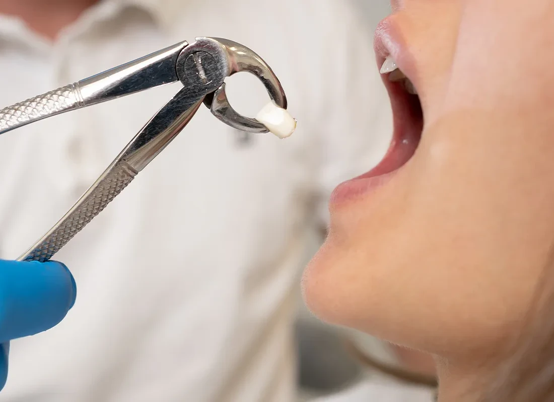 Tooth Extraction in Redlands, CA