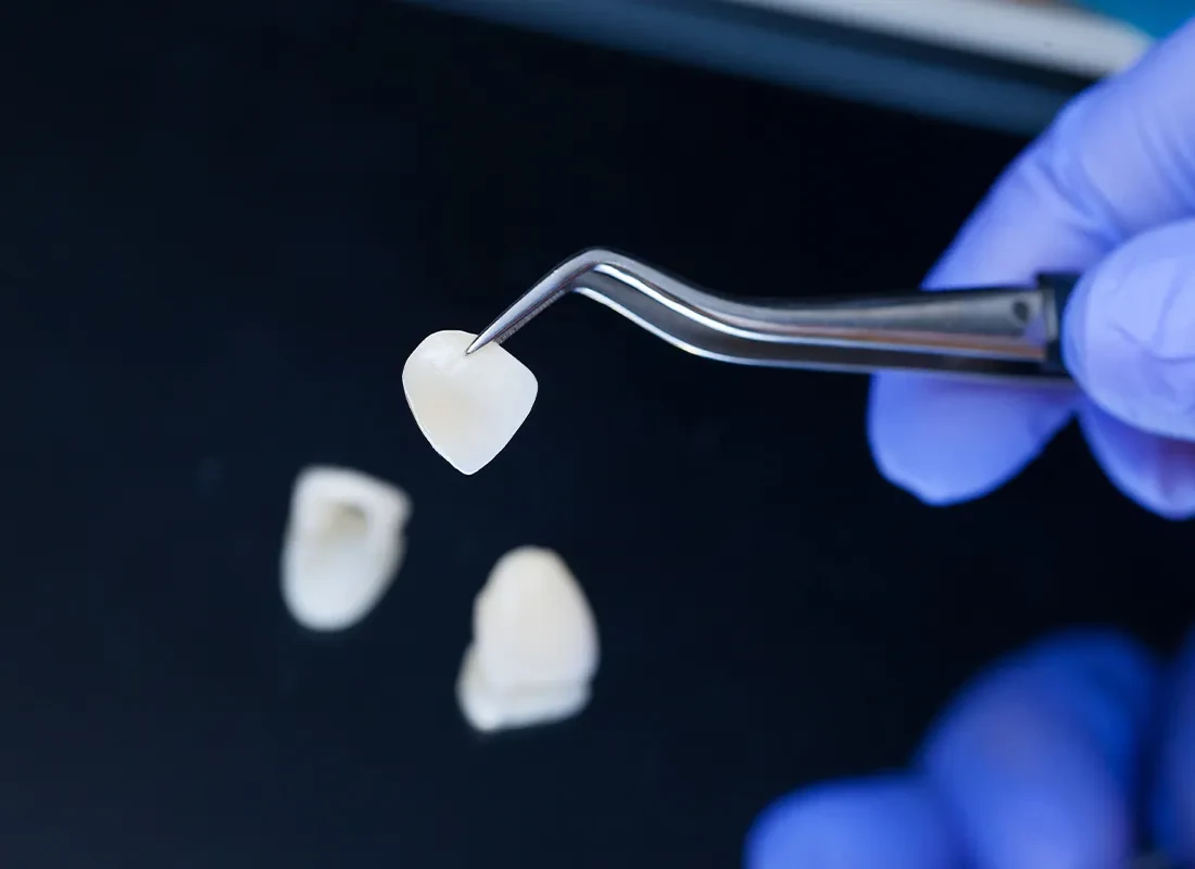Signs you may need dental veneers — Dentist of Redlands