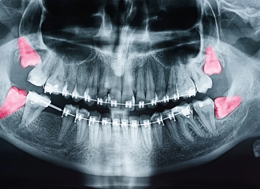 Wisdom Teeth Removal in Redlands, CA